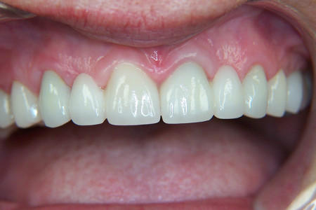 fixed dental bridges